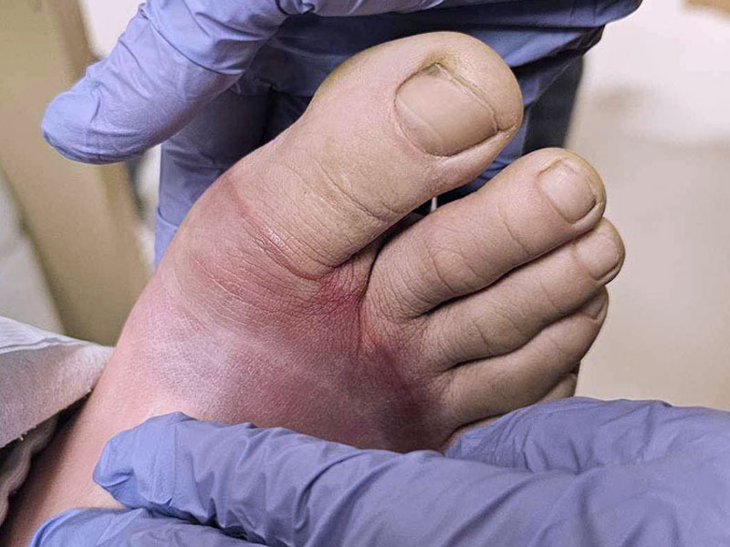 Осголт, хөлдөлтөөс урьдчилан сэргийлээрэй